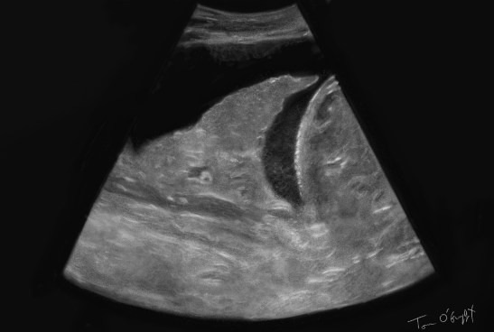pleuresie echographie epanchement pleural