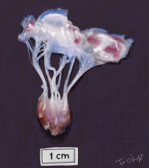rupture muscle papillaire valve cardiaque autopsie