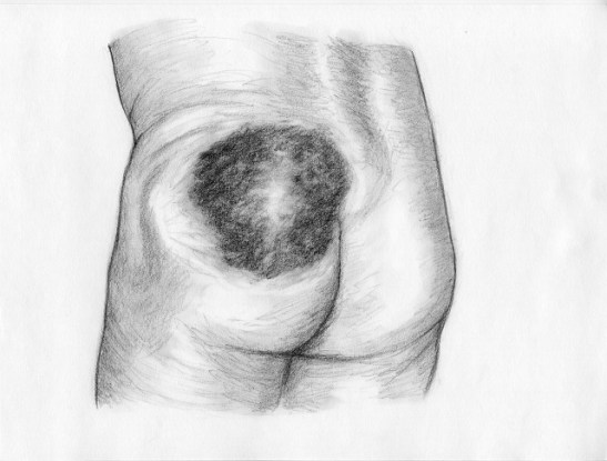 hematome parties molles 3