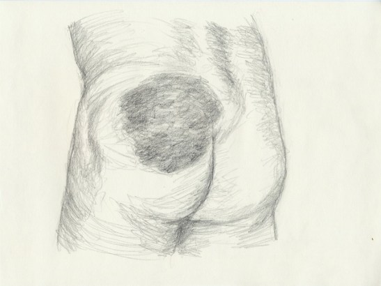 hematome parties molles2