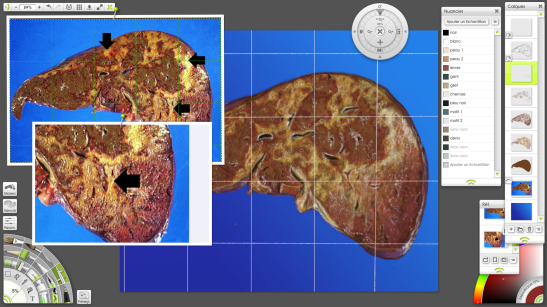 intox paracetamol artrage