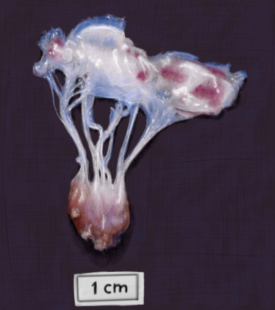 rupture papillaire 4