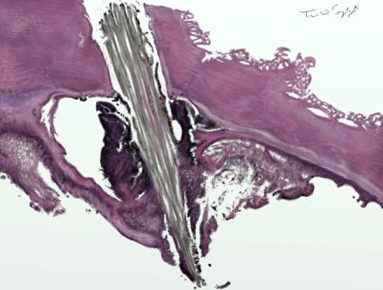 corps etranger bois peau anapath