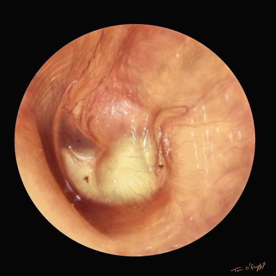 otite moyenne aigue otoscopie