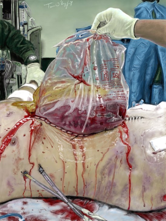 bogota bag damage control laparotomy