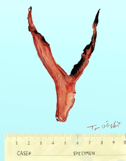 embolie pulmonaire saddle embolism