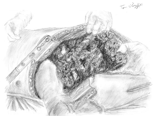 traumatisme hepatique foie