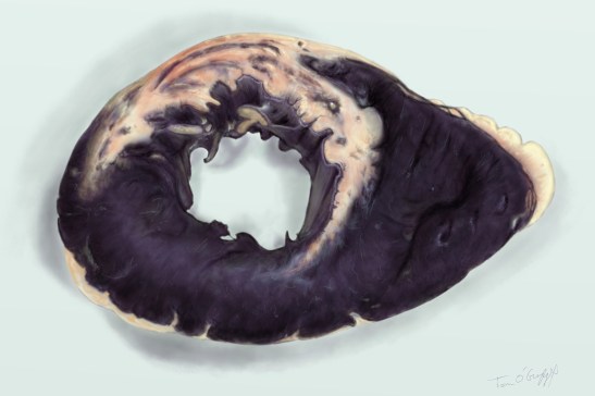 infarctus myocarde preparation bleue