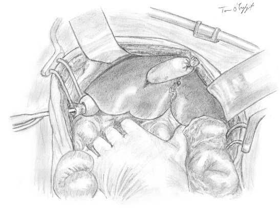 tamponnement laceration hepatique sonde Foley